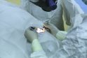 Gydymas: katarakta gydoma operacijos metu pašalinant drumstą lęšiuką ir implantuojant dirbtinį intraokulinį lęšį.